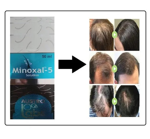 Austro Labs Minoxal Solution, for Hair Growth 60ml Pack of - 1